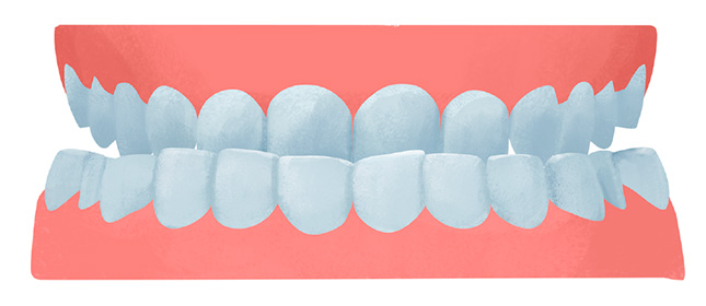 Malocclusions dentaires de classe 3 ou prognathismes mandibulaires
